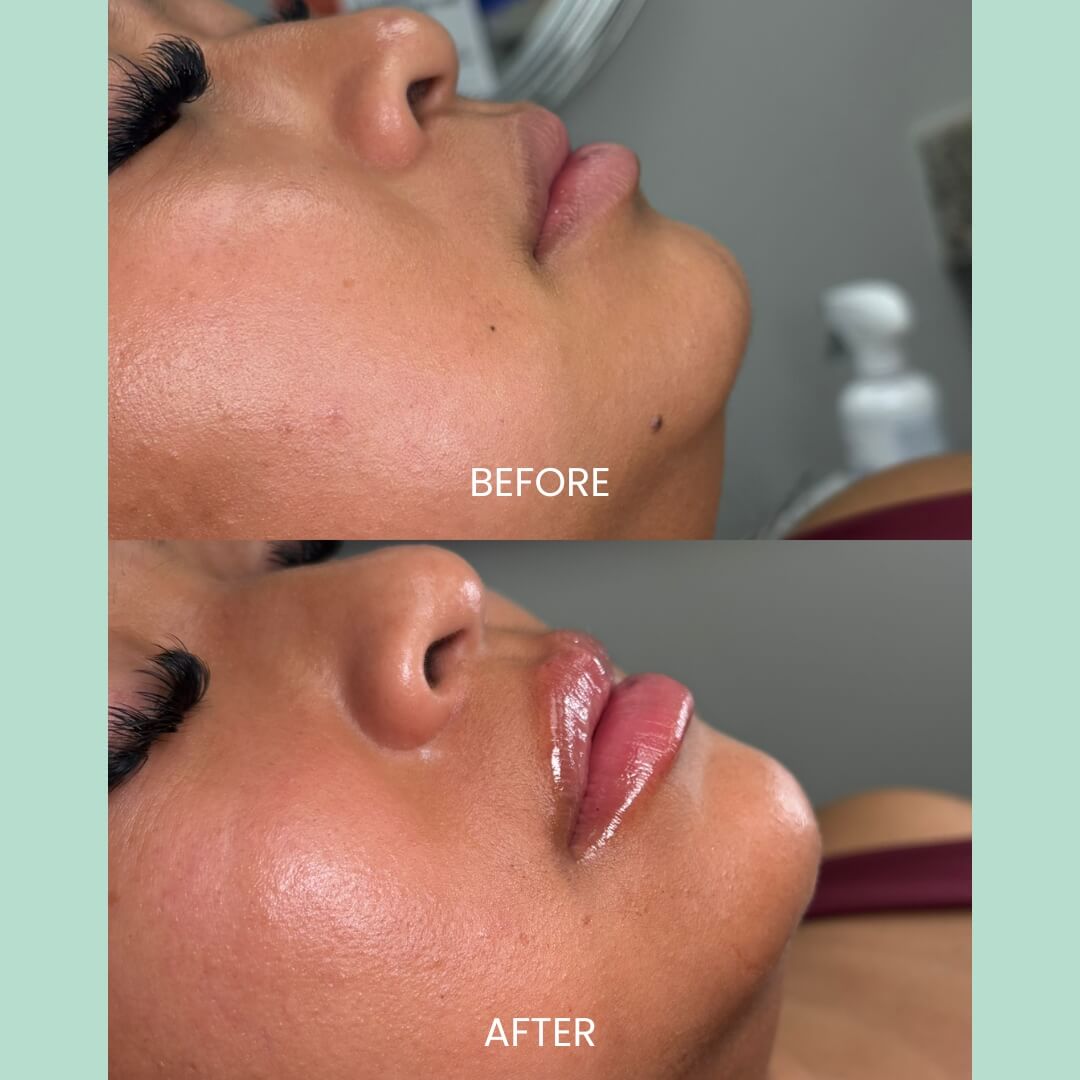 Before and after image showcasing a cosmetic treatment on a woman's face. The top half displays the "before" condition with visible skin texture and a matte finish. The bottom half shows the "after" result, featuring smoother skin with a radiant, dewy appearance and enhanced lip gloss. The background includes a blurred mirror and skincare products, emphasizing the beauty treatment environment. This image highlights the effectiveness of the procedure in improving skin texture and overall appearance.