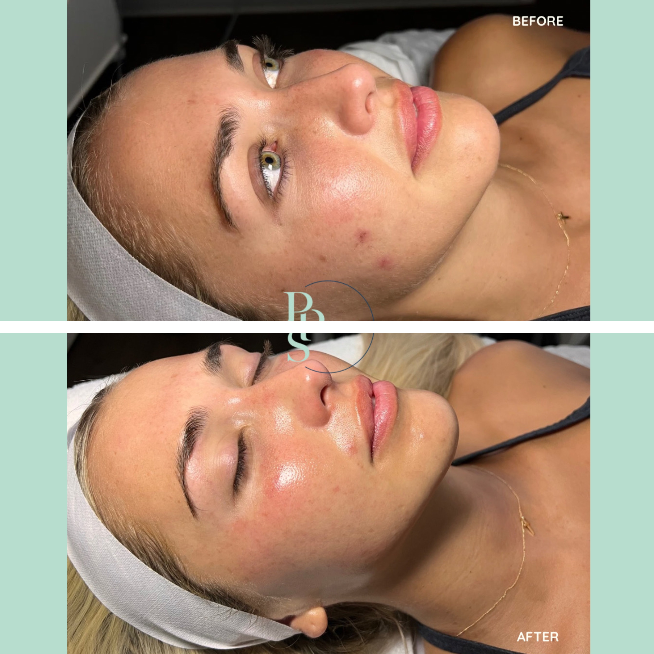 Before and after image showcasing the transformation of a woman's skin following a skincare treatment. The top section labeled "Before" displays her complexion with visible acne and uneven texture, while the bottom section labeled "After" highlights her improved skin condition, featuring a smoother, more radiant appearance. The woman is lying on a treatment bed, wearing a headband, and has a natural, relaxed expression. This visual emphasizes the effectiveness of the skincare regimen in enhancing skin clarity and hydration. Ideal for promoting skincare services and demonstrating
