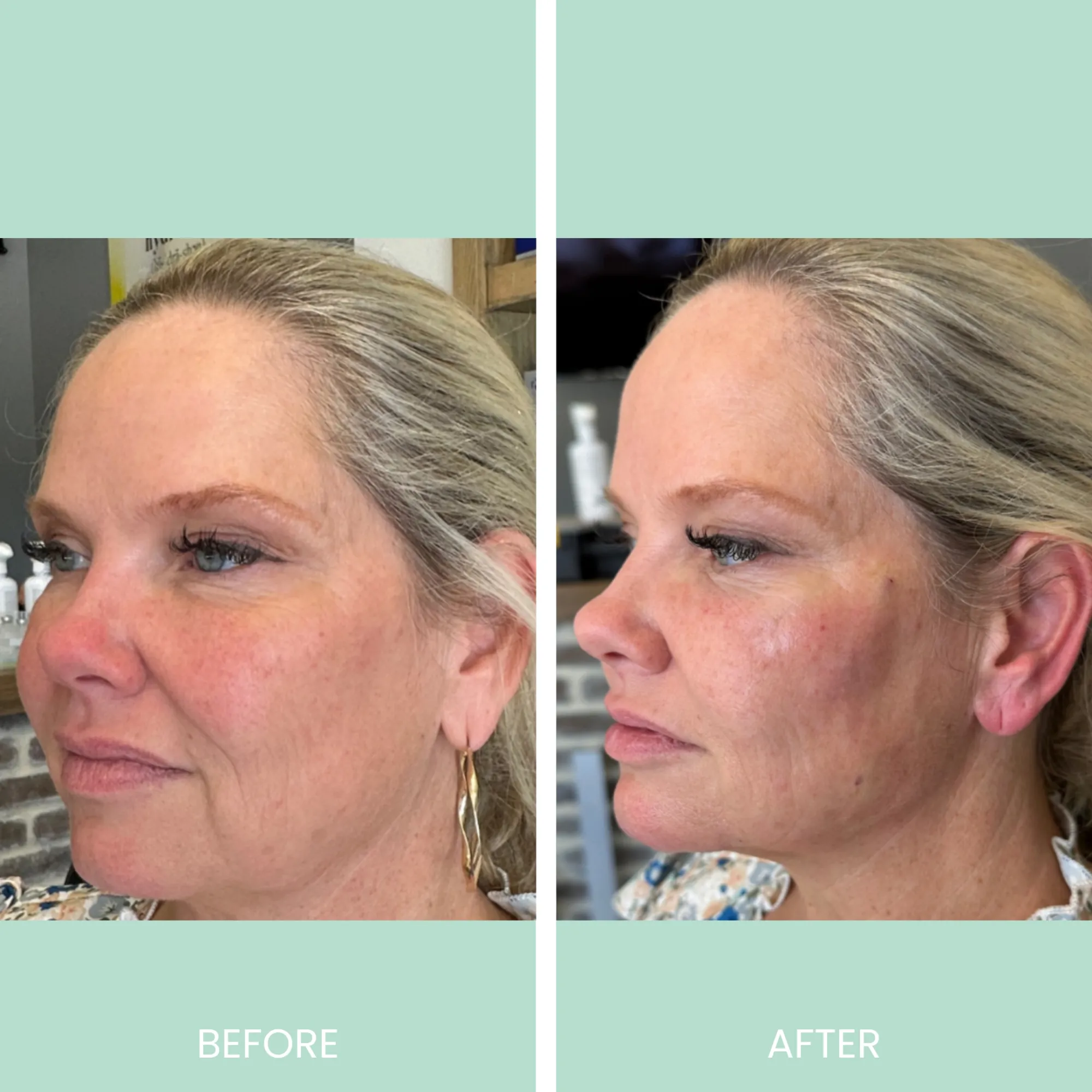 Before and after images showcasing a cosmetic treatment on a woman's face. The left side displays her appearance prior to the treatment, highlighting visible wrinkles and uneven skin tone. The right side illustrates the results post-treatment, revealing smoother skin, improved complexion, and reduced signs of aging. Both images are taken from a side profile perspective, emphasizing the transformation. The background includes subtle elements related to a beauty treatment environment, enhancing the context of the images.