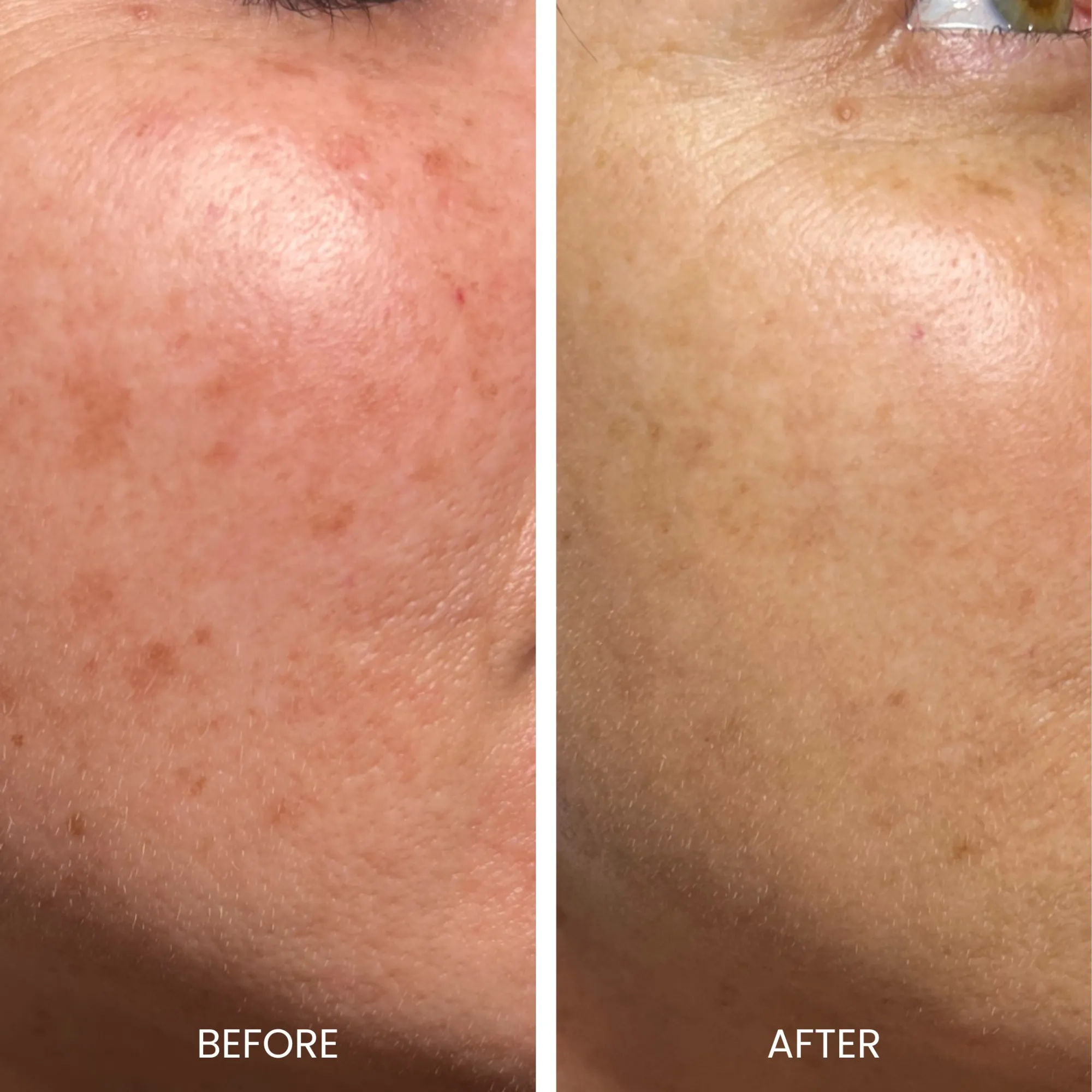 Before and after comparison of facial skin treatment results. The left side shows skin with visible dark spots and uneven texture, while the right side displays smoother, clearer skin with reduced pigmentation. This image highlights the effectiveness of skin care treatments in improving skin appearance and texture. Ideal for those seeking solutions for skin concerns like hyperpigmentation and uneven tone.