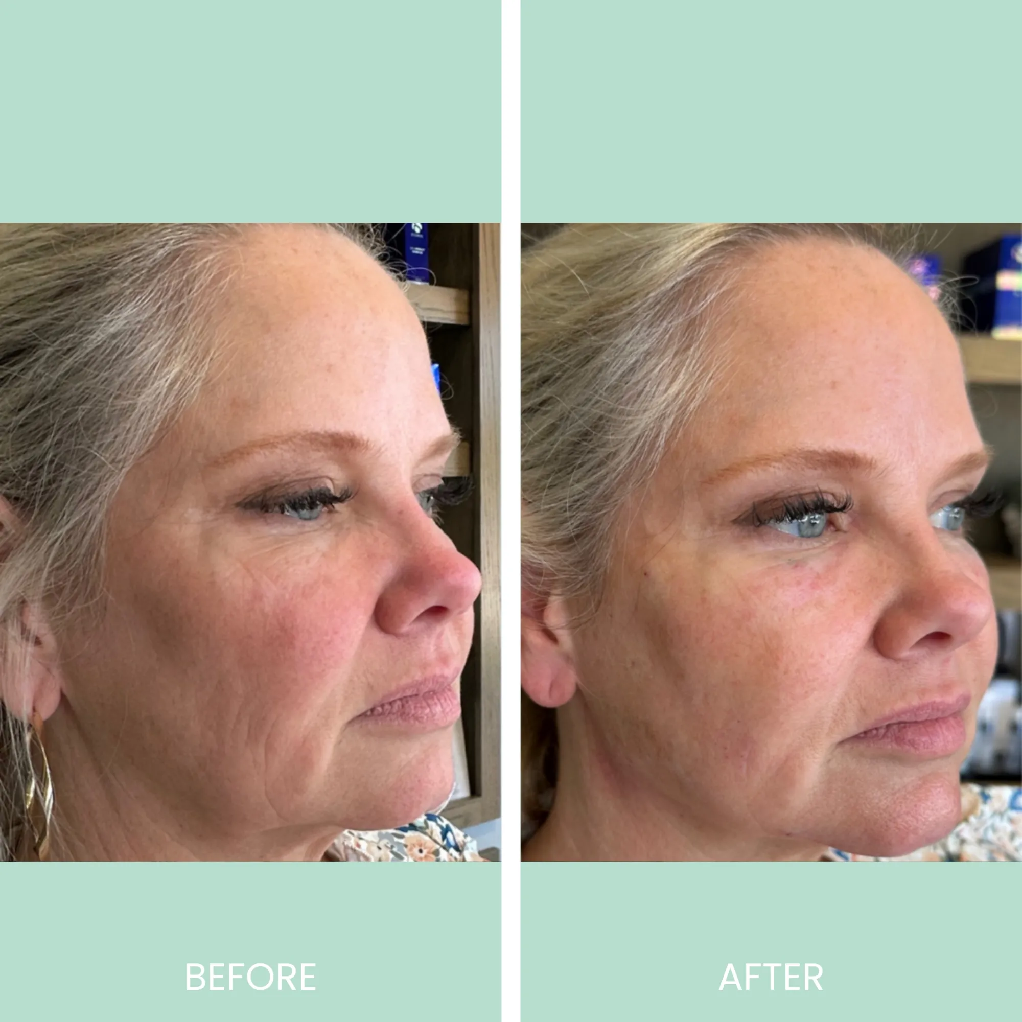 Before and after images showcasing facial rejuvenation results. The left side displays the "before" condition with visible signs of aging, including wrinkles and sagging skin. The right side presents the "after" condition, highlighting improved skin texture, reduced wrinkles, and a more youthful appearance. Both images focus on the side profile of a woman with blonde hair, illustrating the transformation achieved through skincare or cosmetic treatment. The background features a neutral setting, emphasizing the subject's face. These images serve as a visual testament