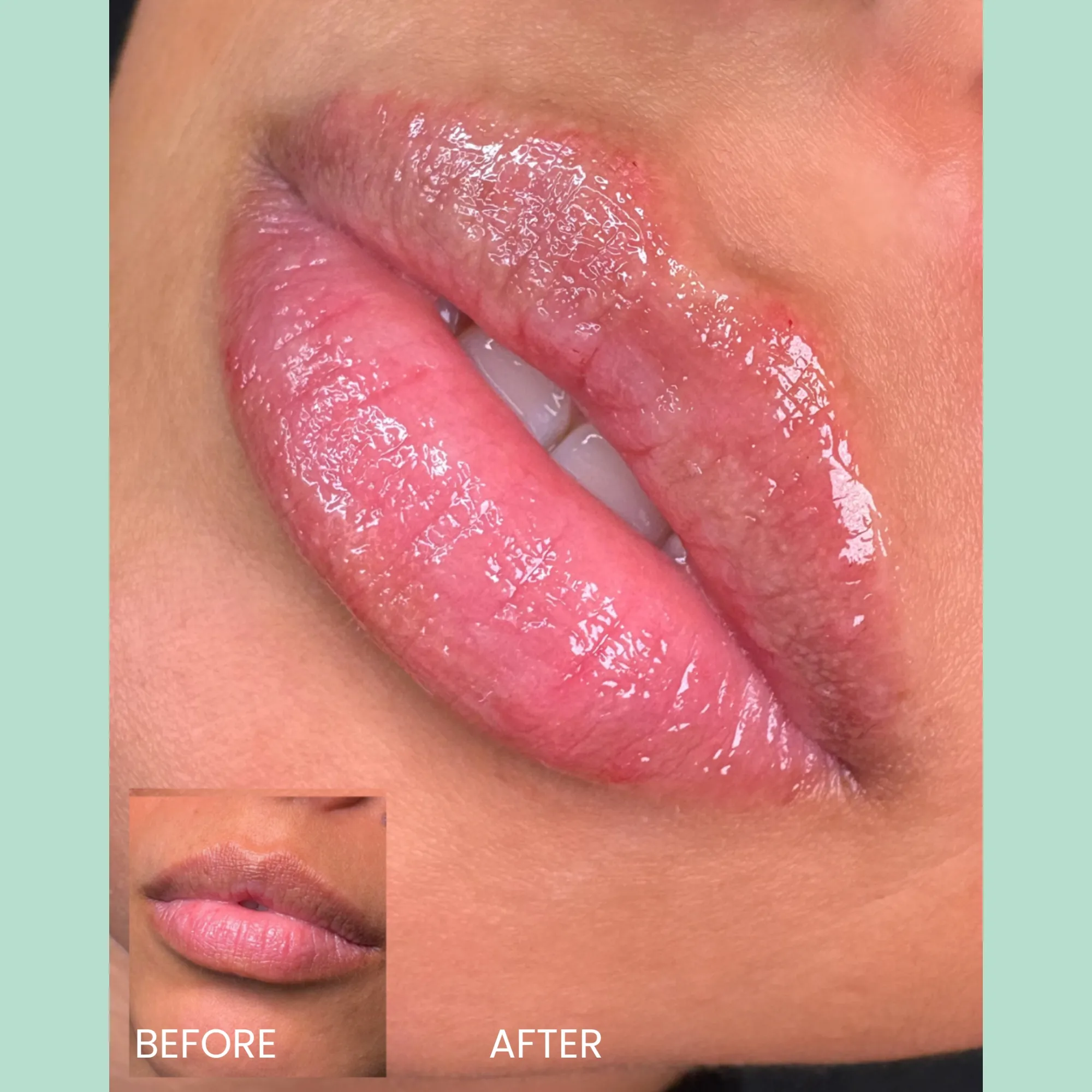 Close-up image showing the transformation of lips after a cosmetic treatment. The left side features the "before" state with natural, unenhanced lips, while the right side displays the "after" results, showcasing fuller, glossier lips with a smooth appearance. An inset image at the bottom left further illustrates the "before" view for comparison. This visual highlights the effectiveness of lip enhancement procedures, emphasizing the improved volume and hydration of the lips. Ideal for beauty and cosmetic treatment discussions, the image conveys