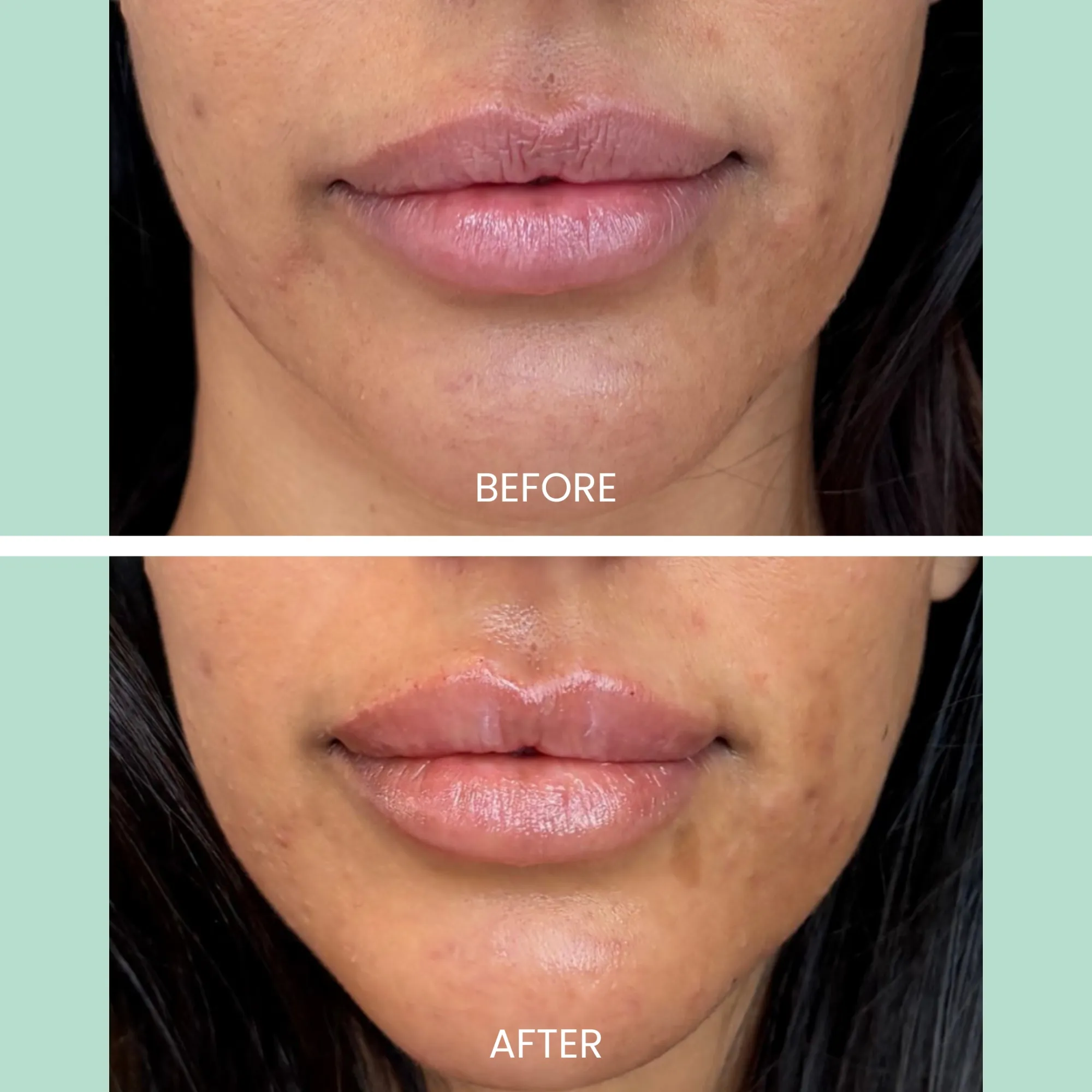 Image comparing the appearance of lips and skin before and after treatment. The top half labeled "Before" shows dry, uneven skin texture with visible blemishes around the mouth area. The bottom half labeled "After" displays smoother, more hydrated lips and improved skin tone with reduced blemishes, highlighting the effectiveness of the treatment. This visual demonstrates significant improvement in skin health and aesthetic appeal, emphasizing the benefits of skincare treatments.