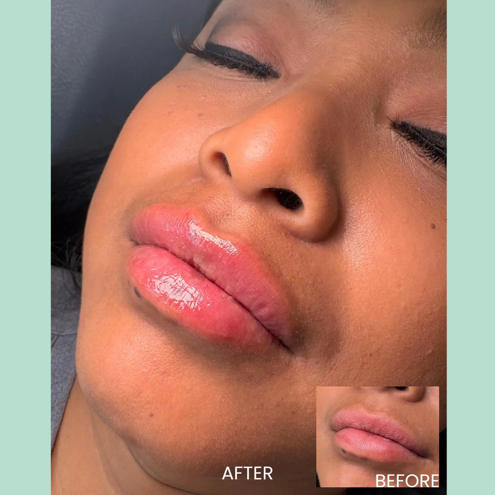 Close-up image showing the transformation of a person's lips after a cosmetic enhancement procedure. The left side displays the fuller, glossy appearance of the lips after treatment, labeled "AFTER." The inset on the right shows the lips before the procedure, labeled "BEFORE." The image highlights the improved volume and shape of the lips, emphasizing the aesthetic results achieved through the treatment. The background is softly blurred to keep the focus on the lips. This visual representation serves as an informative guide for potential clients considering similar