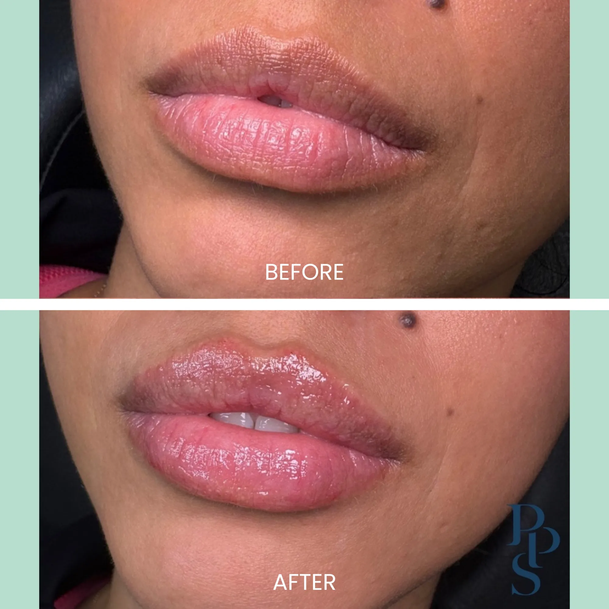 Before and after image showcasing lip enhancement results. The top section displays the lips before treatment, highlighting a natural, subtle appearance with minimal gloss. The bottom section illustrates the enhanced lips post-treatment, featuring a fuller, more defined shape and a glossy finish. This comparison emphasizes the transformation achieved through cosmetic procedures, providing a visual representation of the potential benefits for individuals considering lip enhancement options.