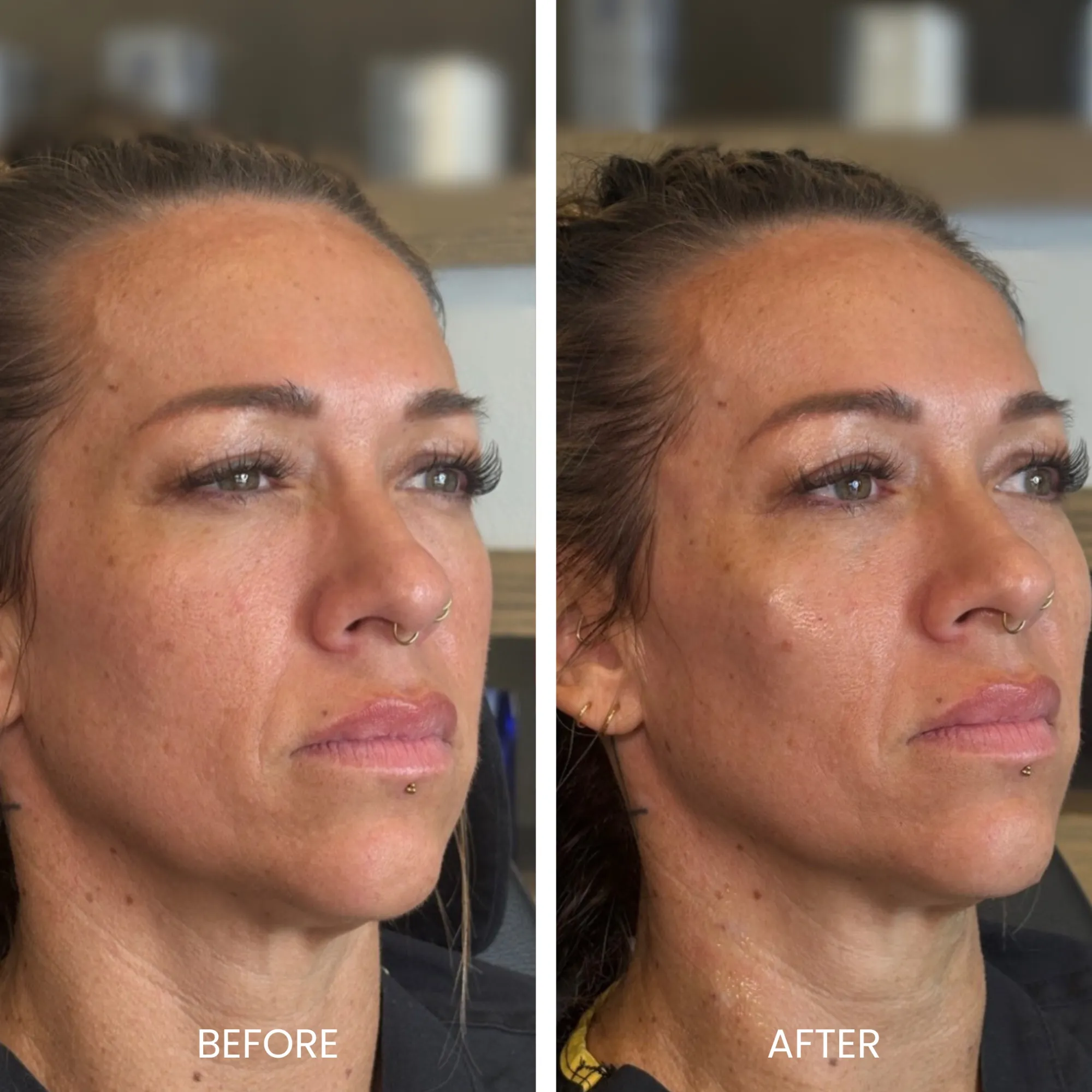 Before and after image showcasing a woman's facial transformation. The left side displays her appearance prior to a skincare treatment, highlighting visible signs of aging and uneven skin tone. The right side illustrates the results post-treatment, revealing smoother skin, improved texture, and a more radiant complexion. The background features a neutral setting, emphasizing the subject's face. This image effectively demonstrates the positive impact of skincare treatments on facial aesthetics.