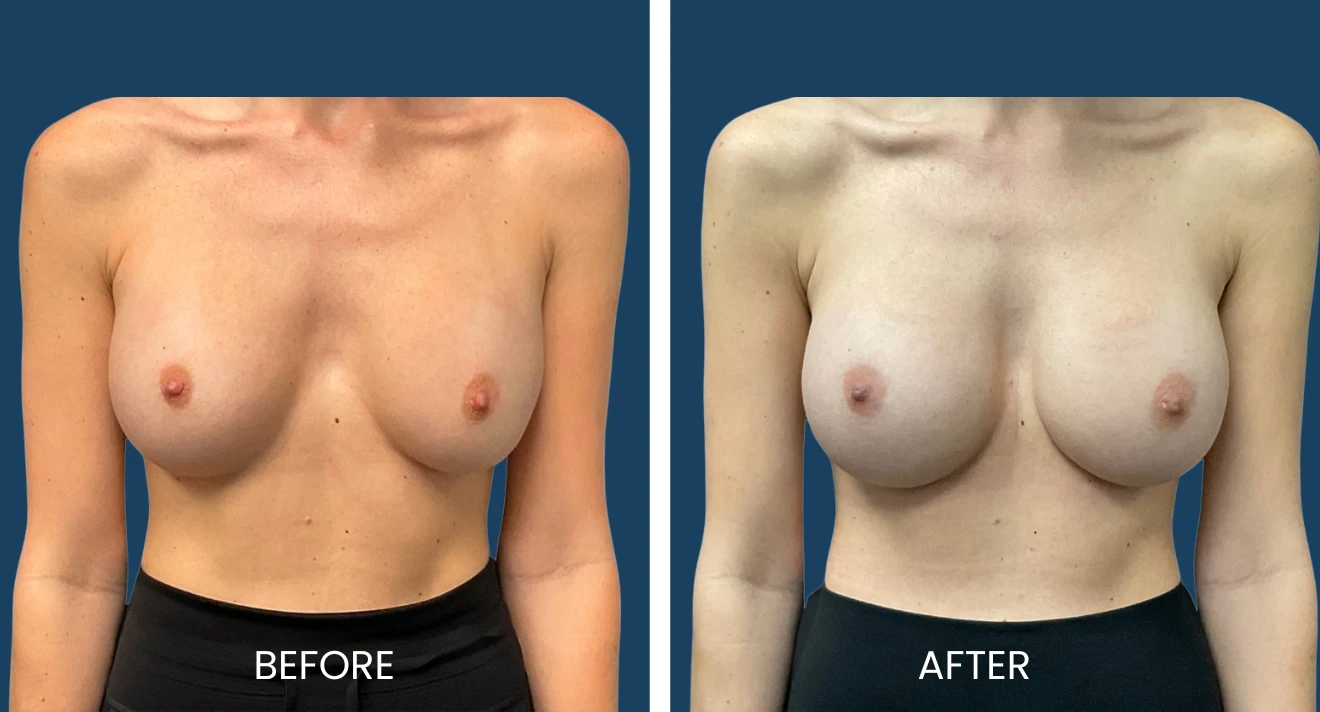Before and after images showcasing breast augmentation results. The left side displays the "before" appearance, highlighting the natural shape and size. The right side presents the "after" transformation, illustrating enhanced volume and symmetry. Both images are set against a neutral background, emphasizing the changes in the subject's breast contours. This visual comparison is useful for individuals considering breast enhancement procedures, providing insight into potential outcomes.