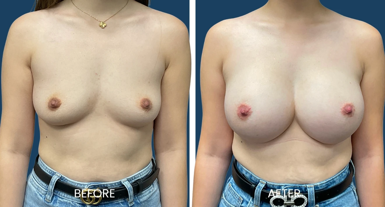 Image comparison showing a woman's chest before and after a cosmetic breast enhancement procedure. The left side labeled "Before" displays the natural appearance, while the right side labeled "After" shows the enhanced results, highlighting increased fullness and shape. The background is a solid blue, providing contrast to the subject. This image is intended to illustrate the transformative effects of breast augmentation, emphasizing aesthetic improvements.