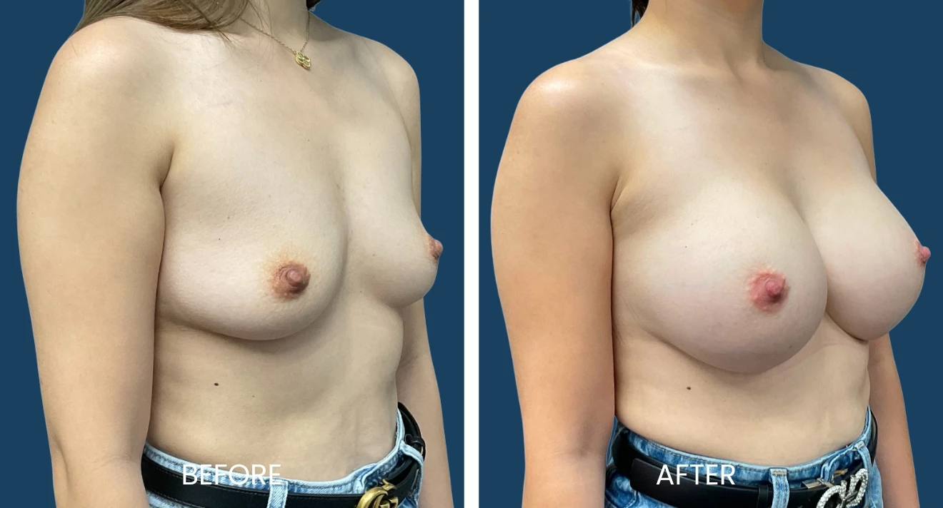 Before and after images showcasing breast enhancement results. The left image displays the "before" state, highlighting the natural breast shape and size. The right image shows the "after" state, demonstrating the enhanced volume and contour achieved through the procedure. Both images are presented from a side angle, allowing for a clear comparison of the transformation. The background is a solid color to emphasize the subject. This visual representation aims to inform viewers about the potential outcomes of breast augmentation.