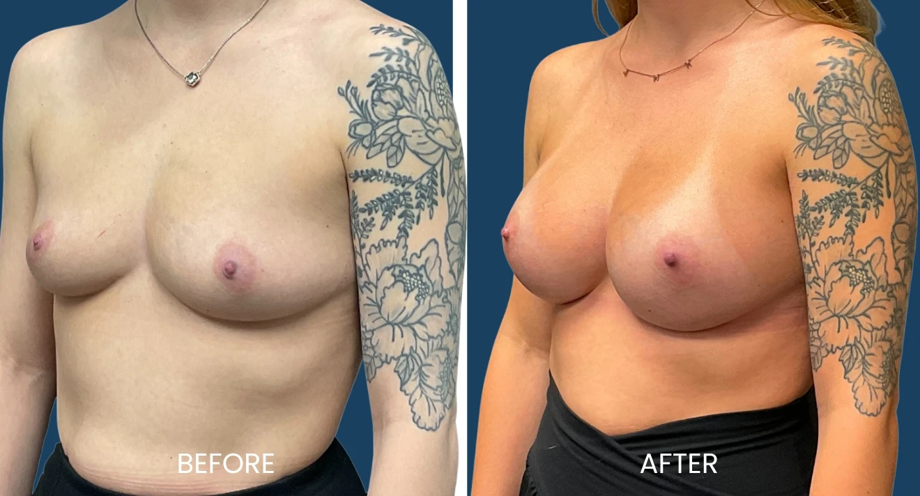 Before and after images showcasing a breast augmentation procedure. The left side displays the individual prior to the surgery, highlighting a flat chest with visible tattoos on the arm. The right side presents the results post-surgery, revealing fuller breasts and a more contoured appearance. Both images are set against a blue background, emphasizing the transformation. This visual representation can help potential patients understand the aesthetic changes achievable through breast augmentation.