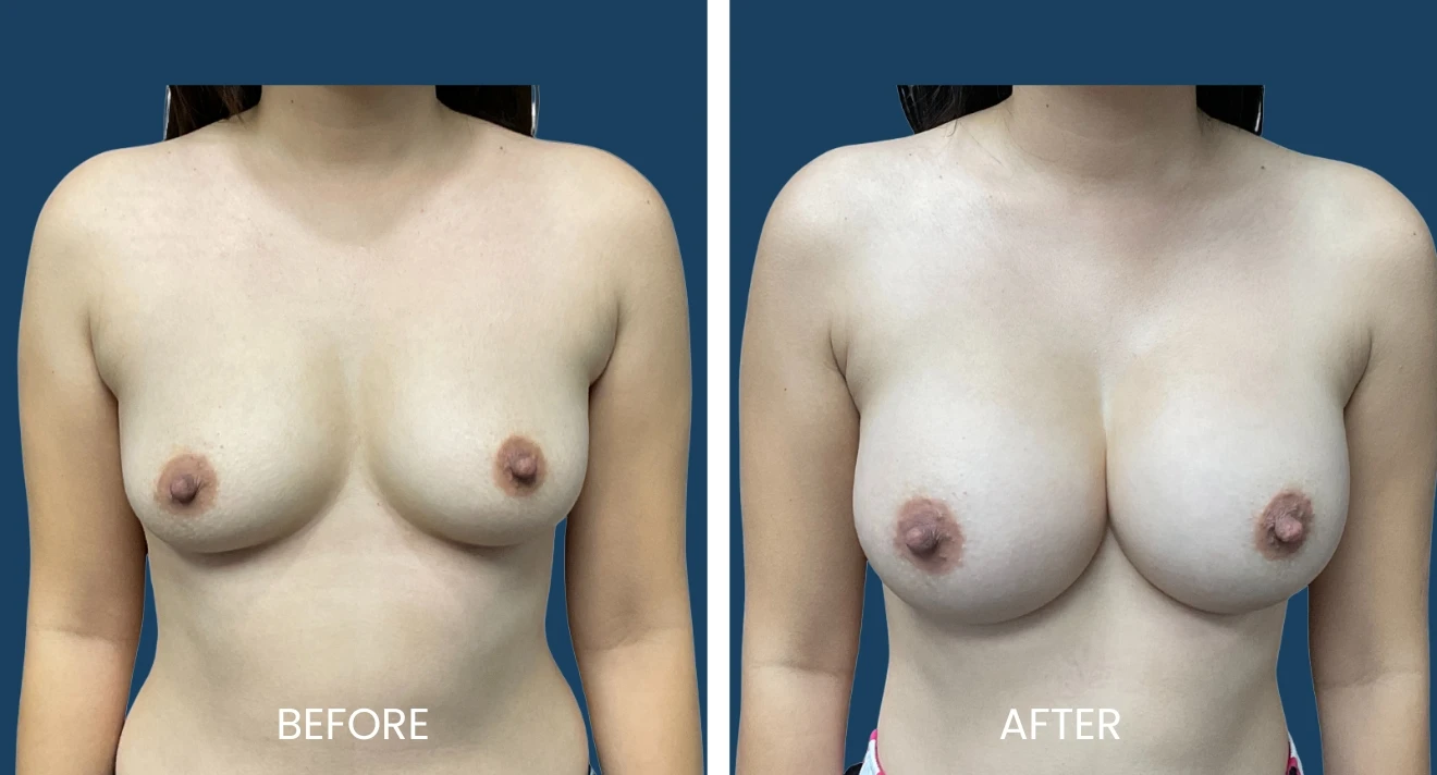 Before and after images of a breast augmentation procedure, showcasing the transformation in breast size and shape. The left side displays the patient's appearance prior to the surgery, while the right side illustrates the results post-procedure. Both images are presented against a solid blue background for clarity. This visual comparison highlights the aesthetic enhancements achieved through breast augmentation, emphasizing improved contour and volume. Ideal for educational purposes related to cosmetic surgery options and outcomes.