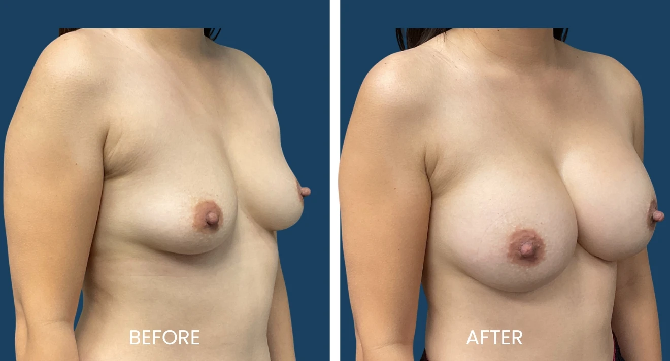 Before and after images showcasing breast augmentation results. The left side displays the initial appearance, while the right side illustrates the enhanced shape and volume post-procedure. Both images highlight the natural look and contour achieved through the surgical process, providing a clear visual comparison for potential patients considering breast enhancement options.