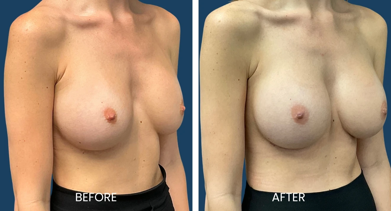 Before and after images showcasing the results of a breast enhancement procedure. The left side displays the "before" image, highlighting the natural appearance, while the right side features the "after" image, demonstrating improved shape and contour. Both images are presented side by side for comparison, emphasizing the transformation achieved through the procedure. This visual representation aims to inform potential patients about the outcomes of breast enhancement options, enhancing understanding of aesthetic changes.