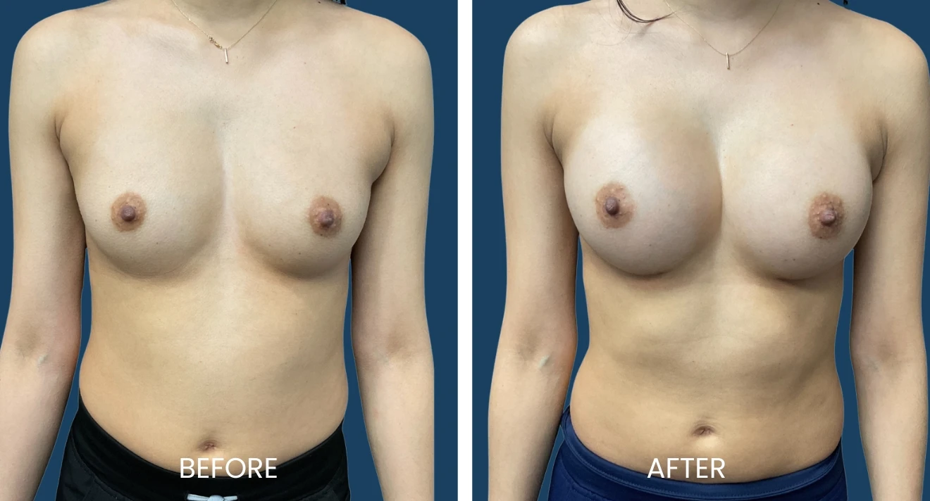 Before and after images of breast augmentation, showcasing the transformation in breast size and shape. The left image labeled "Before" displays a flatter chest, while the right image labeled "After" highlights fuller, enhanced breasts. Both images feature a neutral background, focusing on the results of the procedure. This visual comparison is intended for educational purposes, illustrating the potential outcomes of breast enhancement surgery.