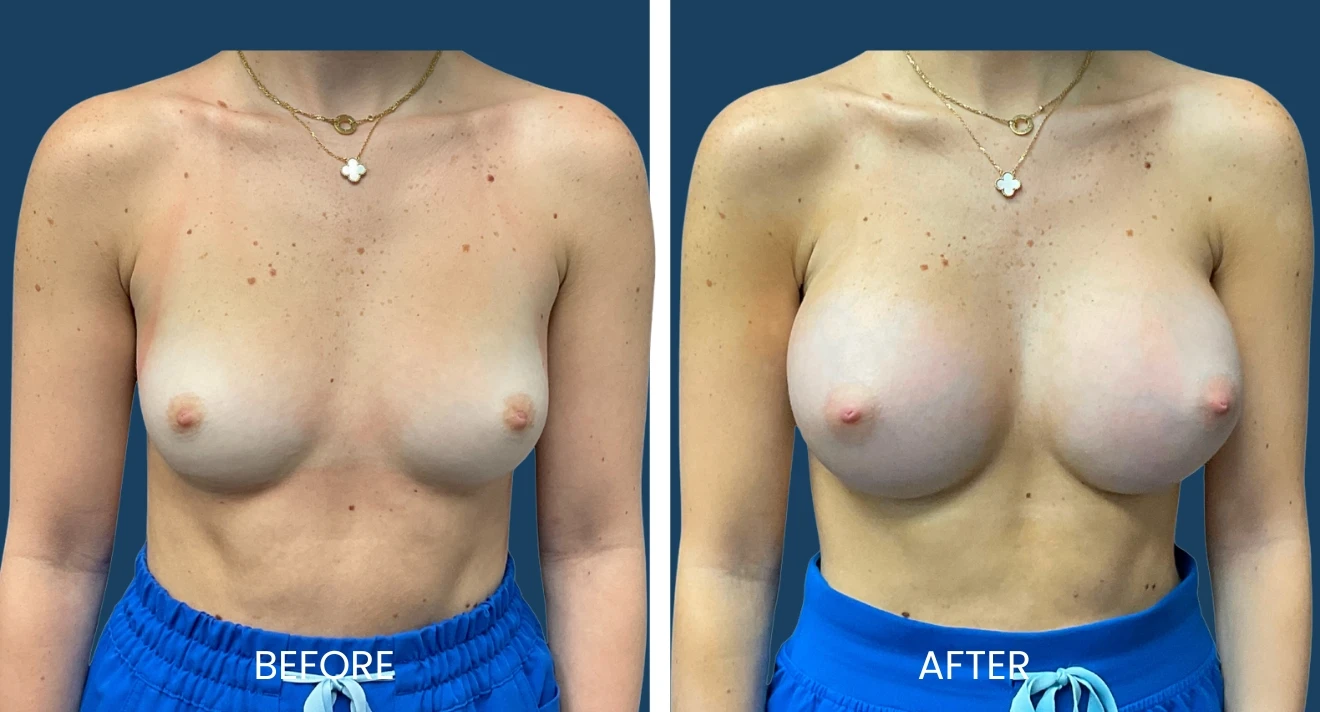 Before and after image showcasing breast enhancement results. The left side displays the "before" appearance, highlighting natural breast shape and size. The right side presents the "after" look, demonstrating enhanced volume and contour. Both images feature a neutral background, allowing for clear visibility of the changes. The subject wears a delicate necklace, contributing to the overall aesthetic without drawing attention away from the breast enhancement results. This visual comparison is useful for potential patients considering breast augmentation or similar procedures, emphasizing the transformation achieved through surgical