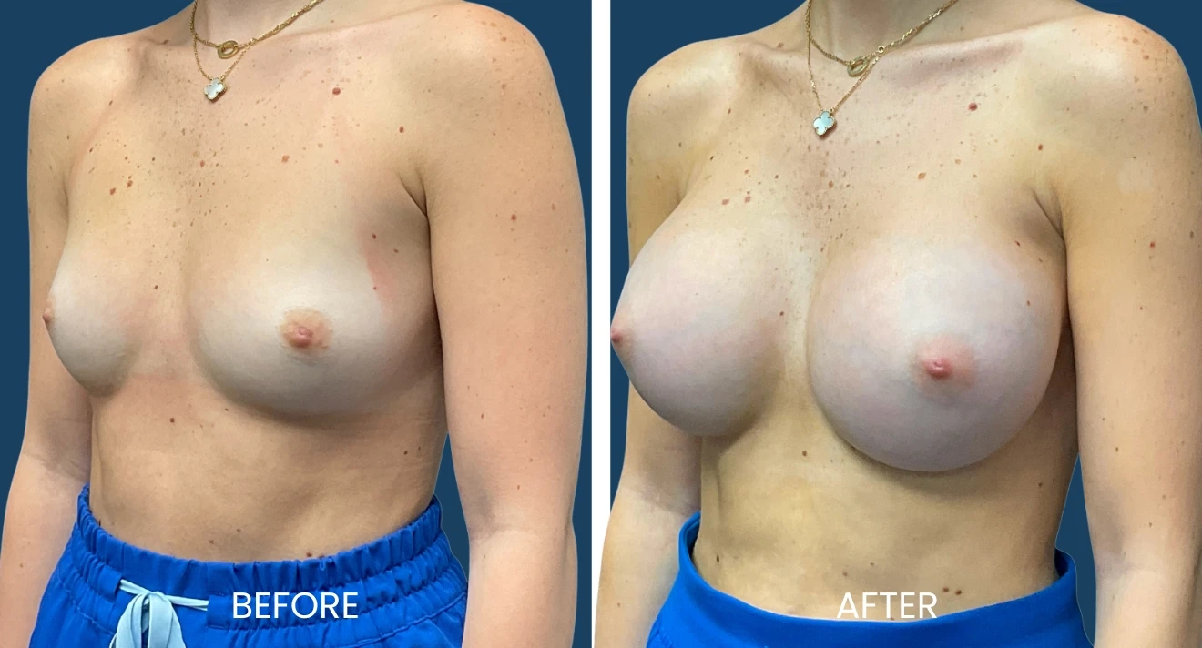 Before and after images showcasing breast augmentation results. The left side displays the patient's appearance prior to the procedure, revealing a natural breast shape with minimal volume. The right side illustrates the enhanced breast contour and increased volume following the augmentation. Both images feature the patient wearing blue athletic shorts and a delicate necklace, set against a neutral background. These visuals provide a clear comparison for individuals considering similar cosmetic enhancements, highlighting potential outcomes and improvements in breast aesthetics.