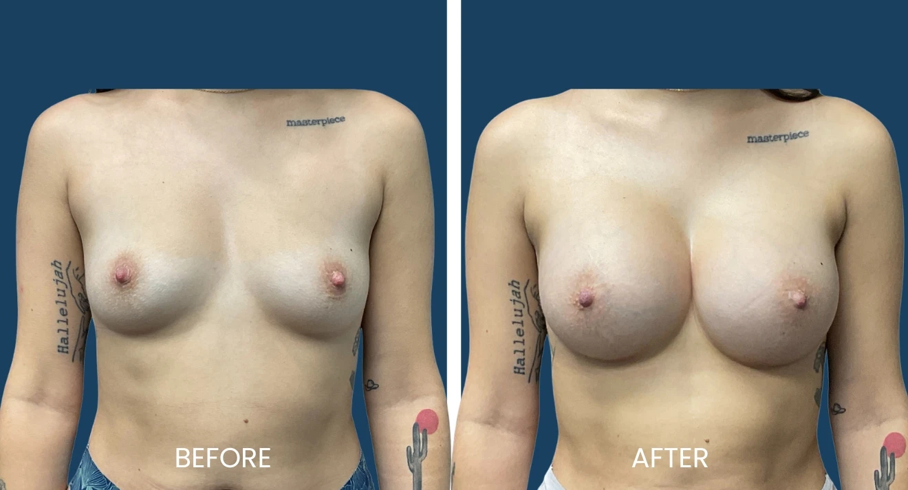 Before-and-after image showcasing breast augmentation results. The left side displays the "before" appearance, while the right side highlights the enhanced look following the procedure. Both images feature a similar angle and background for easy comparison, emphasizing the changes in breast size and shape. This visual representation illustrates the potential outcomes of breast enhancement surgery, aimed at individuals considering cosmetic procedures for aesthetic improvement.