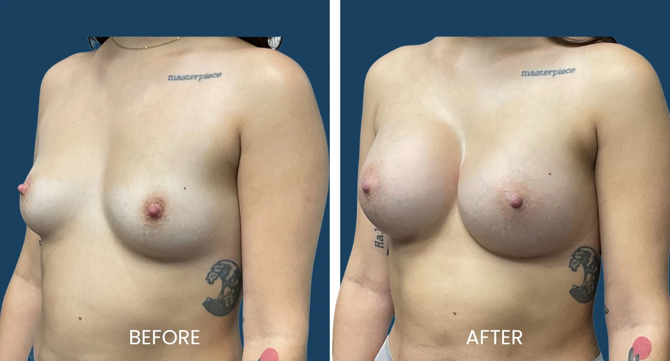 Before and after image comparison of breast augmentation results. The left side shows the "before" appearance, highlighting the natural breast shape and size, while the right side displays the "after" results, showcasing increased volume and enhanced contour. Both images emphasize the transformation achieved through the procedure, illustrating the aesthetic improvements. The subject has visible tattoos on the arms, contributing to the overall look. This image serves to inform potential patients about the outcomes of breast augmentation surgery, enhancing understanding of the procedure's effects.