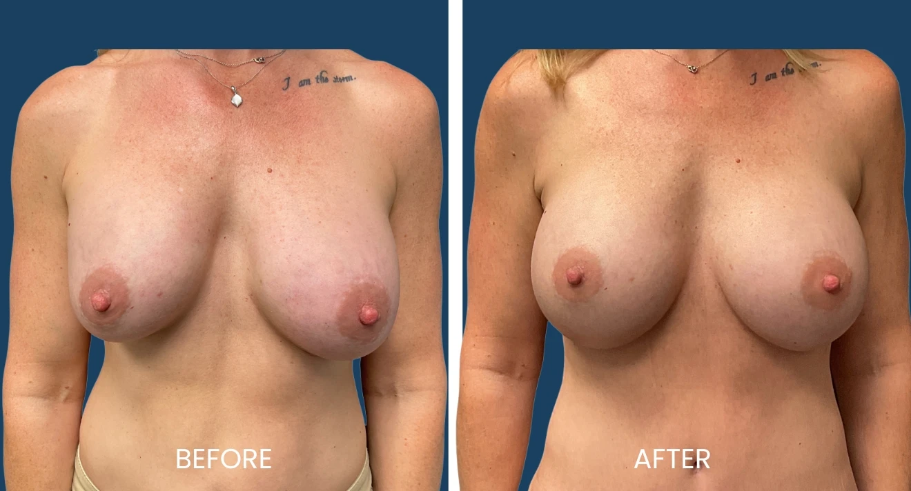 Before and after image comparison of breast enhancement results, showcasing significant aesthetic improvements. The left side displays the "before" state with noticeable asymmetry and skin texture, while the right side presents the "after" result, highlighting enhanced shape and symmetry. Both images feature a neutral background to emphasize the subject's transformation. Ideal for individuals considering breast augmentation or enhancement procedures, this visual representation illustrates the potential outcomes of surgical interventions, supporting informed decision-making.