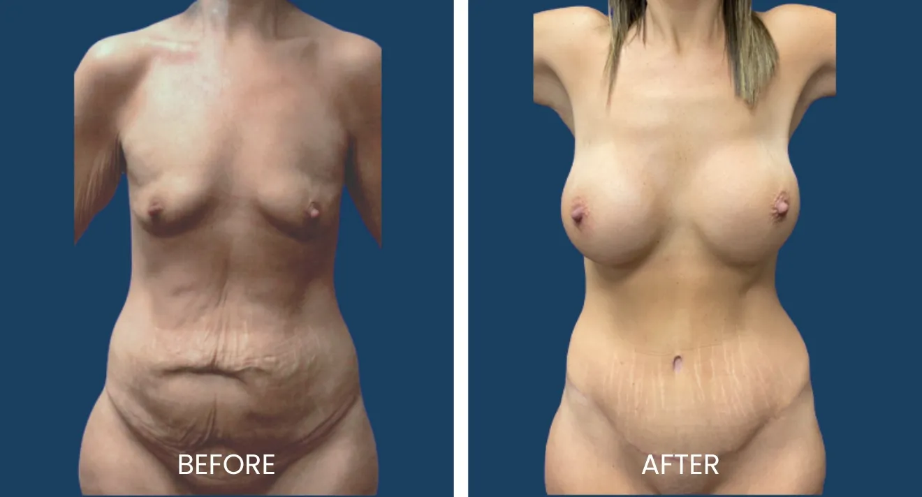 Before and after images showcasing the results of a body contouring procedure. The left side displays the "before" state, highlighting skin laxity and stretch marks, while the right side presents the "after" outcome, demonstrating improved skin tightness and overall body shape. Both images emphasize the transformation achieved through the procedure, illustrating enhanced aesthetic appearance and confidence. Ideal for individuals considering body sculpting options.