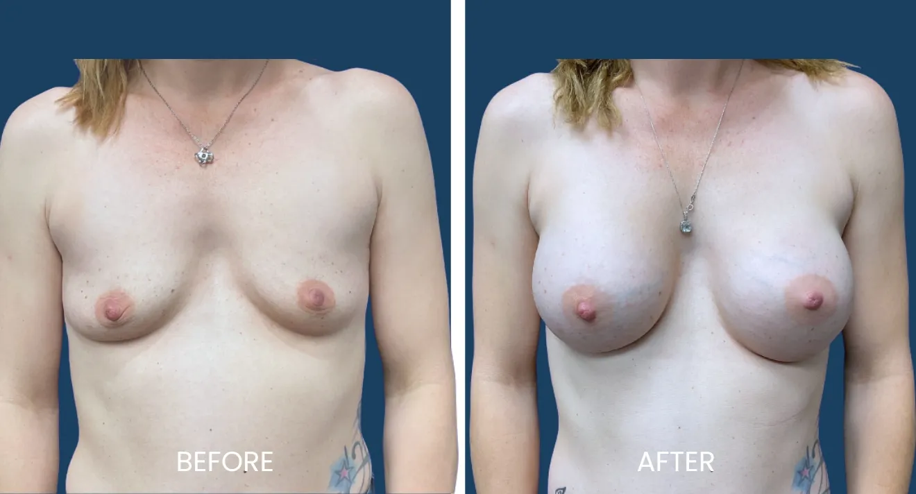 Before and after images showcasing breast augmentation results. The left side displays the 'before' appearance, highlighting the natural shape and size. The right side presents the 'after' results, illustrating enhanced volume and contour following the procedure. Both images capture the same angle for direct comparison, emphasizing the transformation achieved through breast enhancement surgery. Ideal for those considering cosmetic procedures, these visuals provide insight into potential outcomes and help set realistic expectations.