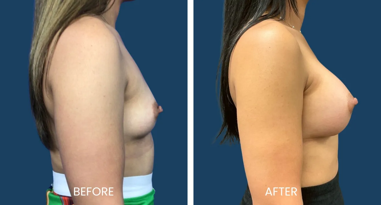 Before and after images showcasing breast enhancement results. The left side displays the "before" view, highlighting a less contoured appearance, while the right side presents the "after" view, demonstrating a fuller and more lifted breast profile. Both images are taken from a side angle against a neutral blue background, emphasizing the transformation achieved through surgical enhancement. This visual comparison aims to inform potential patients about the effects of breast augmentation procedures.