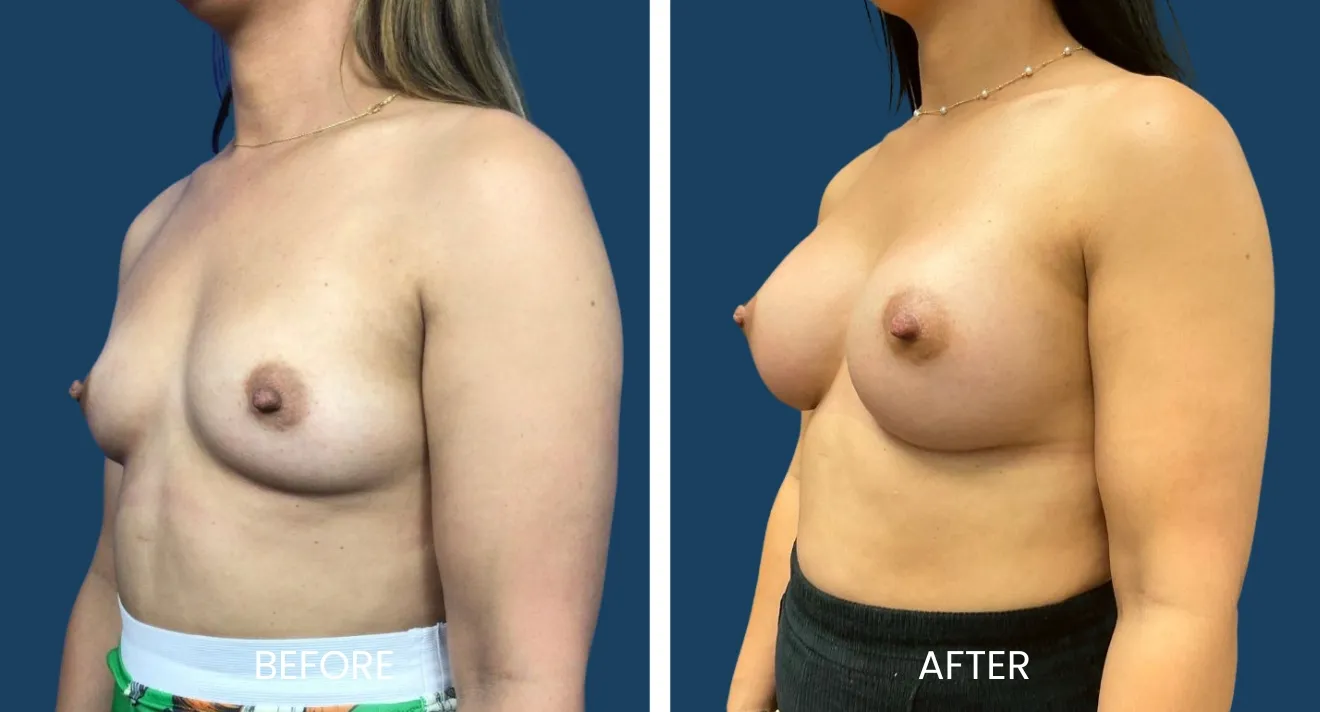 Before and after images showcasing the results of a breast enhancement procedure. The left side displays the "before" appearance, highlighting a flatter chest, while the right side shows the "after" results with fuller breast contours. Both images emphasize the transformation achieved through the procedure, enhancing body confidence and aesthetics. The background is a solid blue, providing contrast to the subject. These images serve as a visual representation for potential patients considering breast enhancement options.
