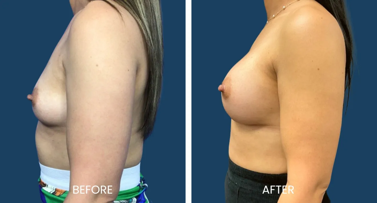 Side-by-side comparison of a woman's breast appearance before and after a cosmetic procedure. The left side shows the "before" image with less fullness and a different shape, while the right side presents the "after" image, highlighting enhanced volume and a more aesthetically pleasing contour. The background is a solid blue, emphasizing the subject. This image illustrates the transformative effects of breast augmentation, showcasing the potential results of the procedure for individuals considering similar enhancements.