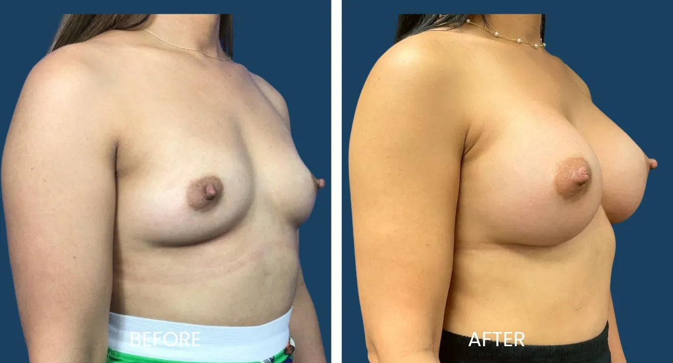 Before and after images showcasing the results of breast augmentation surgery. The left side displays the pre-surgery appearance, highlighting the natural shape and size. The right side illustrates the enhanced breast contour and volume post-surgery. Both images are taken from a side angle to emphasize the differences in appearance. The background is a solid blue, providing contrast to the subject. This visual comparison aims to inform potential patients about the transformative effects of the procedure, promoting body positivity and self-confidence.