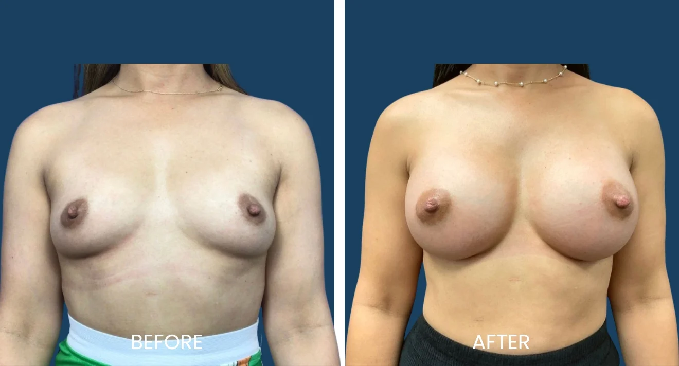 Image comparison showing the results of a breast augmentation procedure. The left side displays the "before" image, highlighting the natural breast shape and size. The right side presents the "after" image, showcasing the enhanced volume and contour achieved through the procedure. This visual aids in understanding the transformative effects of breast augmentation for individuals considering this cosmetic surgery option.
