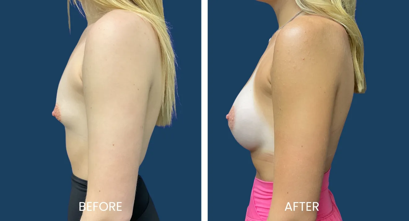 Before-and-after image showcasing a side profile of a woman who underwent a breast enhancement procedure. The left side displays the "before" appearance, highlighting the natural shape, while the right side presents the "after" result, demonstrating a fuller and more contoured look. The background is a solid blue, emphasizing the changes in the subject's silhouette. This image is relevant for discussions on cosmetic surgery, body image, and aesthetic enhancements, providing visual evidence of the transformative effects of such procedures.