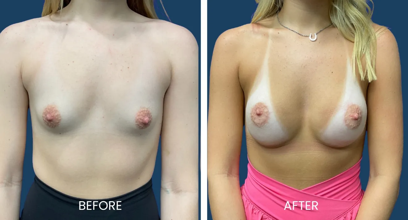 Before and after images showcasing the results of a breast enhancement procedure. The left side displays the original appearance, while the right side highlights the enhanced shape and volume post-procedure. Both images feature a model standing against a solid background, wearing swimwear. The transformation emphasizes improved aesthetics and boosts confidence for individuals considering similar cosmetic enhancements.