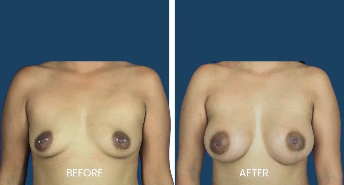 Before and after images comparing breast appearance following a cosmetic procedure. The left image displays the original breast shape and size, while the right image shows the enhanced results post-procedure. Both images are presented against a solid blue background for clarity. This visual representation is intended to inform potential patients about the transformative effects of breast enhancement surgery, highlighting improvements in symmetry and contour.