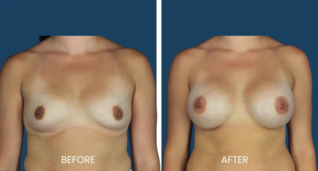 Before and after images demonstrating the results of breast augmentation surgery. The left side shows the "before" appearance, highlighting natural breast shape and size, while the right side illustrates the "after" results, showcasing enhanced volume and contour. Both images are presented against a neutral background for clarity, emphasizing the surgical outcome. This visual comparison is useful for individuals considering breast augmentation, providing insight into potential results and helping them make informed decisions about their options.