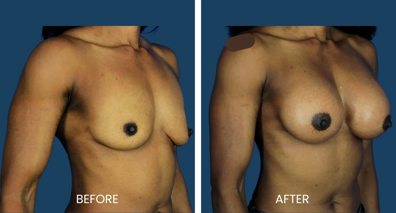 Before and after images showcasing breast augmentation results on a female patient. The left image displays the patient's breast appearance prior to surgery, highlighting natural shape and size. The right image reveals the enhanced breast shape and volume following the procedure, demonstrating a fuller and more symmetrical look. Both images are set against a solid blue background, allowing for clear comparison of the surgical results. This visual representation aims to inform potential patients about the transformation achievable through breast augmentation surgery.