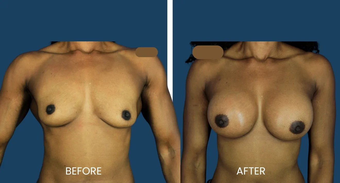 Before and after images showcasing breast augmentation results. The left side displays the "before" condition, highlighting the natural shape and size of the breasts. The right side shows the "after" result, illustrating the enhanced volume and contour achieved through the procedure. Both images focus on the upper body, with a neutral background to emphasize the differences in appearance. These visuals are intended for informational purposes related to cosmetic surgery options.