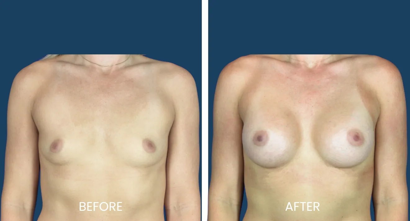 Before and after images showcasing the results of breast augmentation surgery. The left side displays the natural appearance of the breasts prior to the procedure, while the right side illustrates the enhanced shape and fullness achieved post-surgery. Both images emphasize a natural look with consistent skin tone and texture. These visuals are intended to provide potential patients with a clear understanding of the possible outcomes of breast augmentation, promoting informed decision-making regarding cosmetic surgery options.
