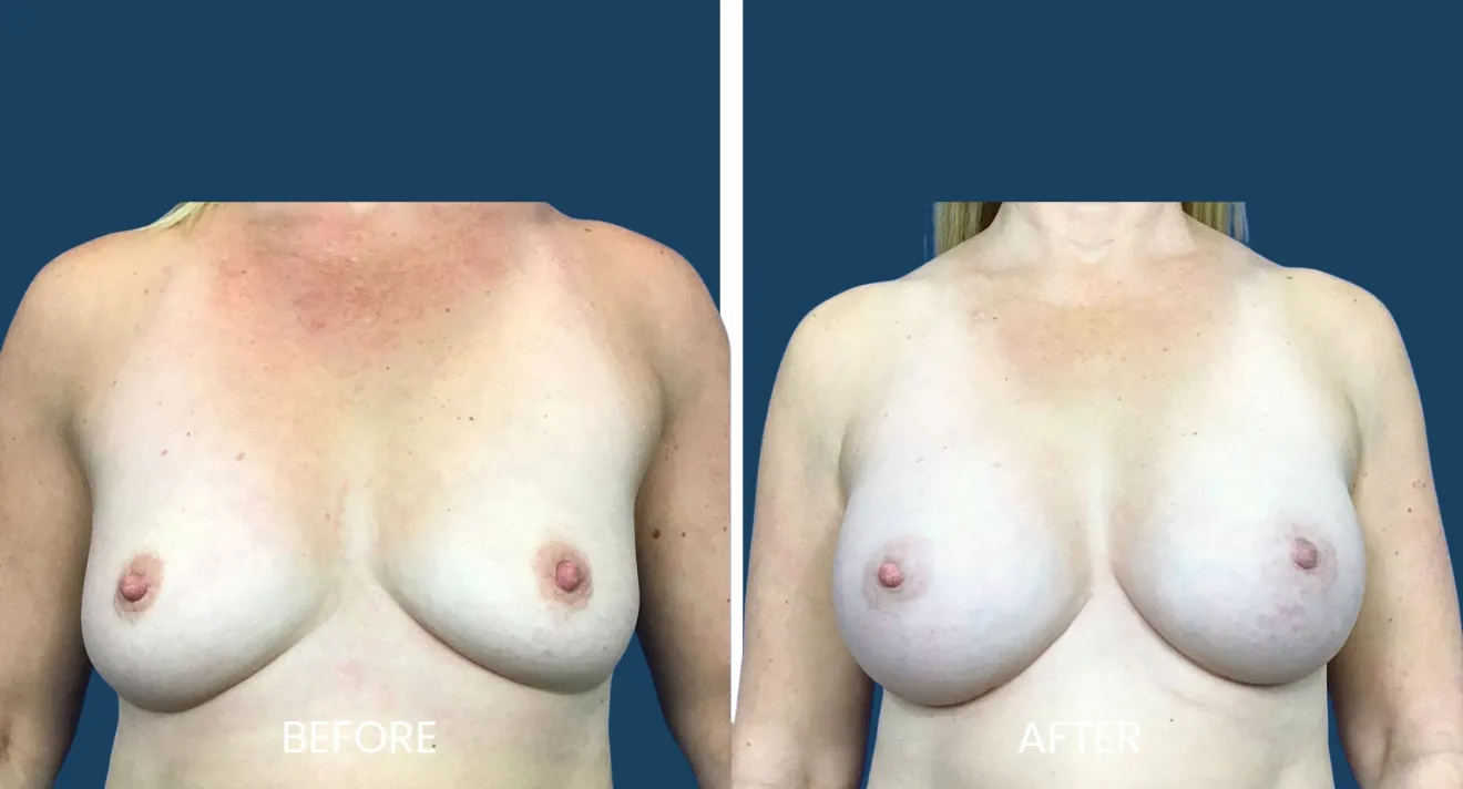Before-and-after image showcasing breast augmentation results. The left side displays the "before" look, highlighting natural breast shape and size. The right side features the "after" appearance, demonstrating enhanced breast volume and contour. Both images are set against a neutral background for clarity. This visual comparison is intended to inform potential patients about the transformative effects of breast augmentation procedures.