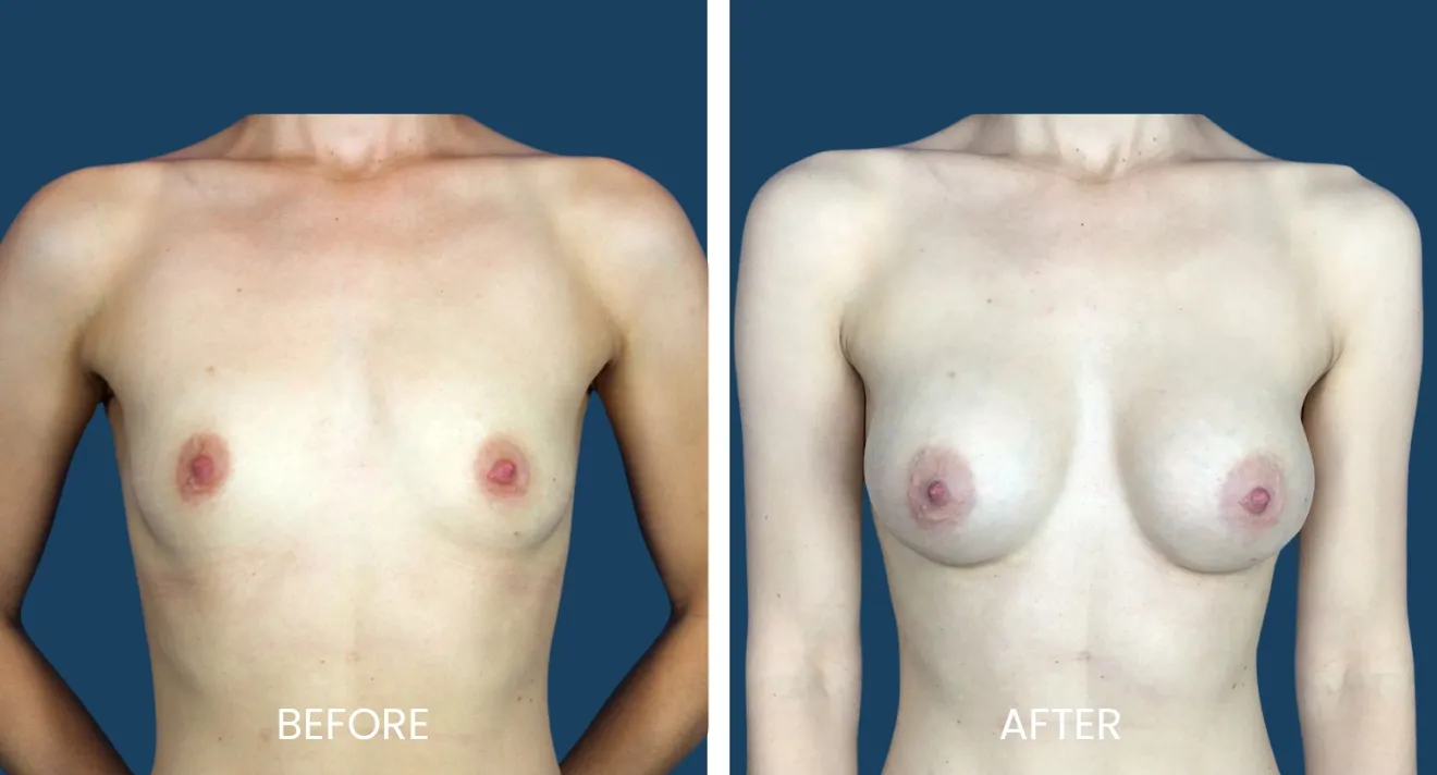 Before and after images showcasing breast augmentation results. The left side displays the initial appearance of the breasts, while the right side illustrates the enhanced shape and volume after the procedure. Both images feature a neutral background for clarity. The visuals are intended to inform potential patients about the transformation that can be achieved through breast enhancement surgery. This comparison highlights the significant changes in breast contour and overall aesthetic improvement following the surgical intervention.
