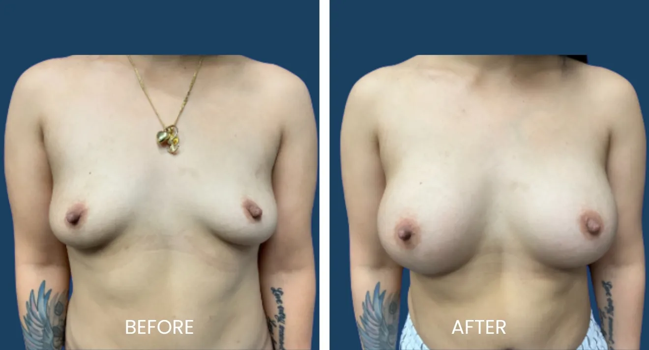Before and after images showcasing breast augmentation results. The left image displays the breast appearance prior to the procedure, while the right image illustrates the enhanced shape and volume following the surgery. Both images are presented with a neutral background to focus on the transformation. This visual comparison highlights the effectiveness of breast augmentation in improving overall aesthetics and may assist individuals considering similar procedures.