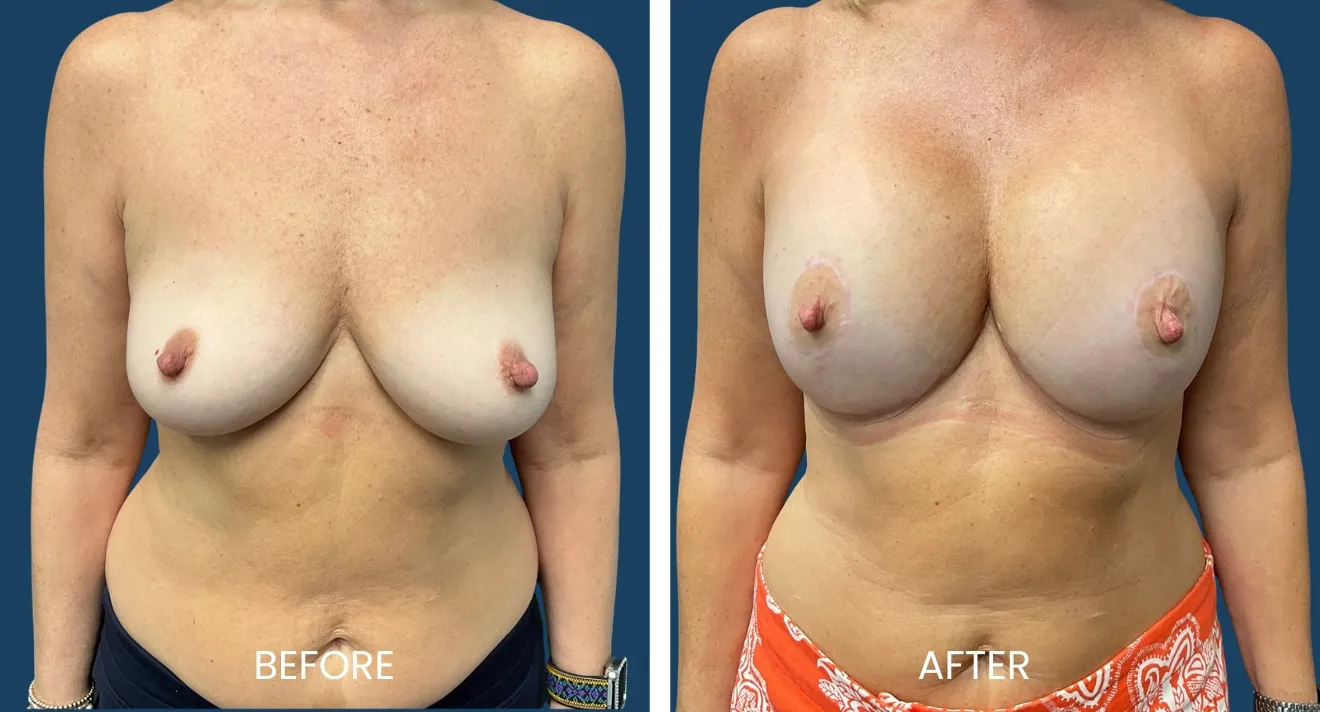 Before and after images showing breast augmentation results, highlighting the transformation in breast shape and volume. The left side displays the "before" appearance, while the right side showcases the enhanced "after" look with improved contour and fullness. These images serve as a visual reference for potential patients considering breast enhancement procedures, illustrating the effectiveness of surgical intervention in achieving desired aesthetic outcomes.