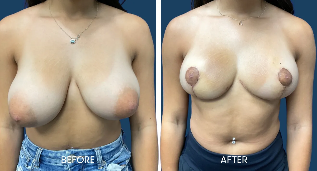 Before and after images showing the results of breast reduction surgery. The left side displays the pre-operative appearance, highlighting fuller breasts, while the right side shows the post-operative results with a reduced breast size. Both images emphasize the surgical transformation and improvement in contour. The background is a solid color to enhance visibility. These visuals serve to inform potential patients about the outcomes of breast reduction procedures, illustrating a common cosmetic surgery option for those seeking relief from discomfort or enhanced body confidence.