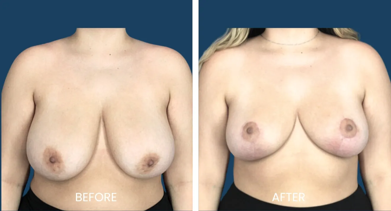 Image comparison showing a breast augmentation procedure. The left side displays the 'before' photo, highlighting the natural breast shape and size, while the right side shows the 'after' result, demonstrating a fuller and more lifted appearance post-surgery. Both images focus on the chest area, providing a clear view of the transformation achieved through the procedure. This visual aids in understanding the potential outcomes of breast enhancement surgeries.