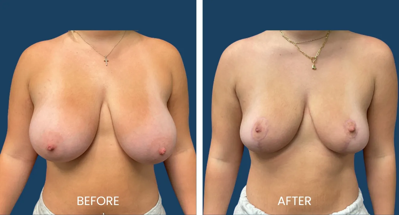 Before and after image comparison of breast augmentation, showcasing significant changes in breast shape and volume. The left side displays the "before" appearance, while the right side illustrates the "after" results post-surgery. Both images emphasize the transformation achieved through the procedure, enhancing the overall aesthetic. The background is a solid blue, providing contrast to the subject. This visual representation serves as a guide for individuals considering breast augmentation, highlighting potential outcomes and improvements in body confidence.