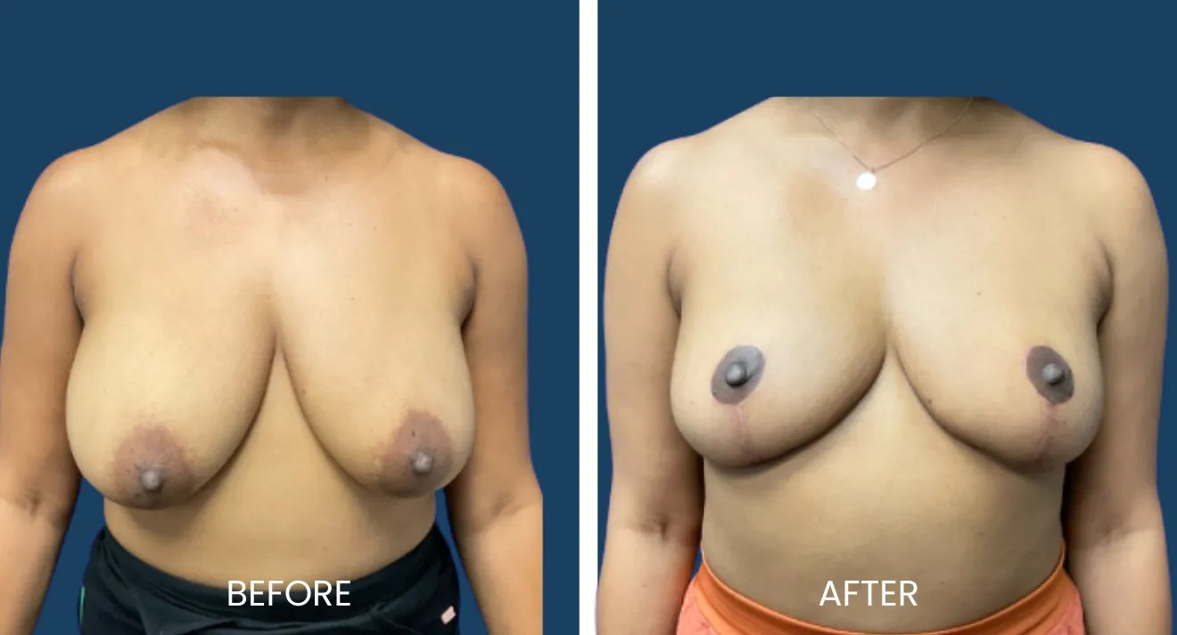 Before and after images demonstrating the results of a breast augmentation procedure. The left side shows the "before" appearance, characterized by a fuller and asymmetrical breast shape. The right side displays the "after" results, showcasing improved symmetry and enhanced breast contours. Both images provide a clear visual comparison, highlighting the transformative effects of the surgical procedure. These visuals serve to educate potential patients about the outcomes of breast augmentation, emphasizing the importance of consultation with a qualified professional for personalized results.