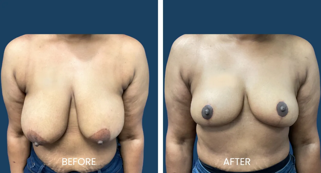 Before and after images of breast reconstruction surgery, showcasing significant aesthetic improvement. The left side displays the pre-operative appearance with asymmetric breast shape and skin texture. The right side illustrates the post-operative results, highlighting a more symmetrical and natural look. These images emphasize the transformative effects of surgical intervention, providing insight into the procedure's potential outcomes for patients considering breast reconstruction.