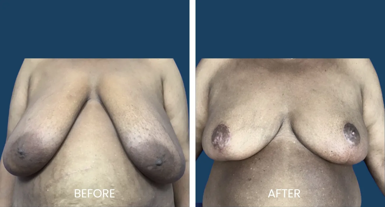 Before and after images showing breast reconstruction results. The left image displays the condition of the breasts prior to the procedure, highlighting asymmetry and skin texture. The right image illustrates the improved appearance post-surgery, with enhanced symmetry and a smoother skin texture. These images are intended to inform potential patients about the outcomes of breast reconstruction surgery, emphasizing the transformative effects on both appearance and confidence.