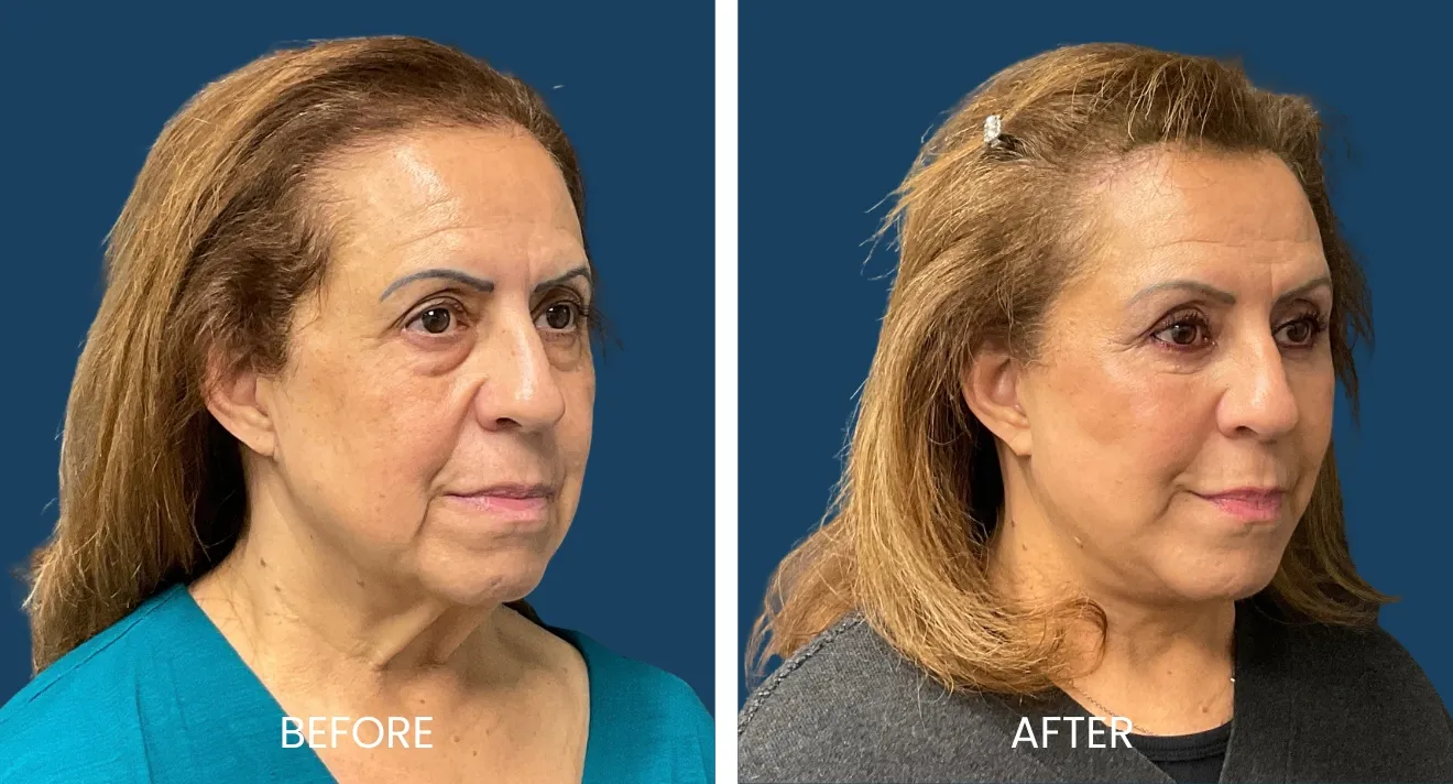 Before and after image showcasing a woman's facial transformation. The left side displays her appearance prior to a cosmetic treatment, highlighting signs of aging such as wrinkles and sagging skin. The right side presents her improved look post-treatment, with smoother skin, enhanced facial contours, and a more youthful appearance. Both images are set against a dark blue background for contrast, allowing clear visibility of the changes. This visual comparison emphasizes the effectiveness of cosmetic procedures in rejuvenating facial aesthetics.