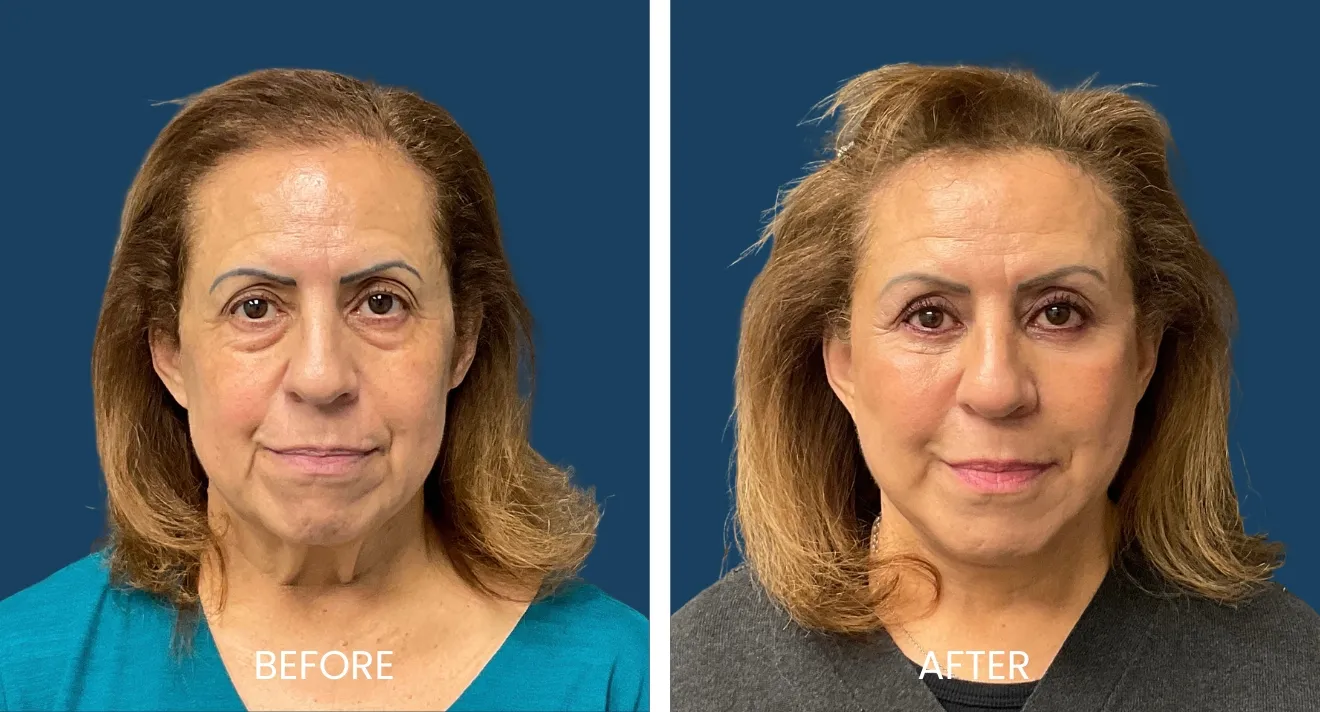 Before and after image showcasing a woman's facial transformation. The left side displays her appearance before a cosmetic procedure, characterized by visible signs of aging and minimal makeup. The right side shows her after the procedure, highlighting a rejuvenated look with smoother skin, enhanced features, and more defined makeup. The background is a solid blue, emphasizing the subject's face. This image illustrates the positive effects of cosmetic treatments on enhancing facial aesthetics and boosting confidence.