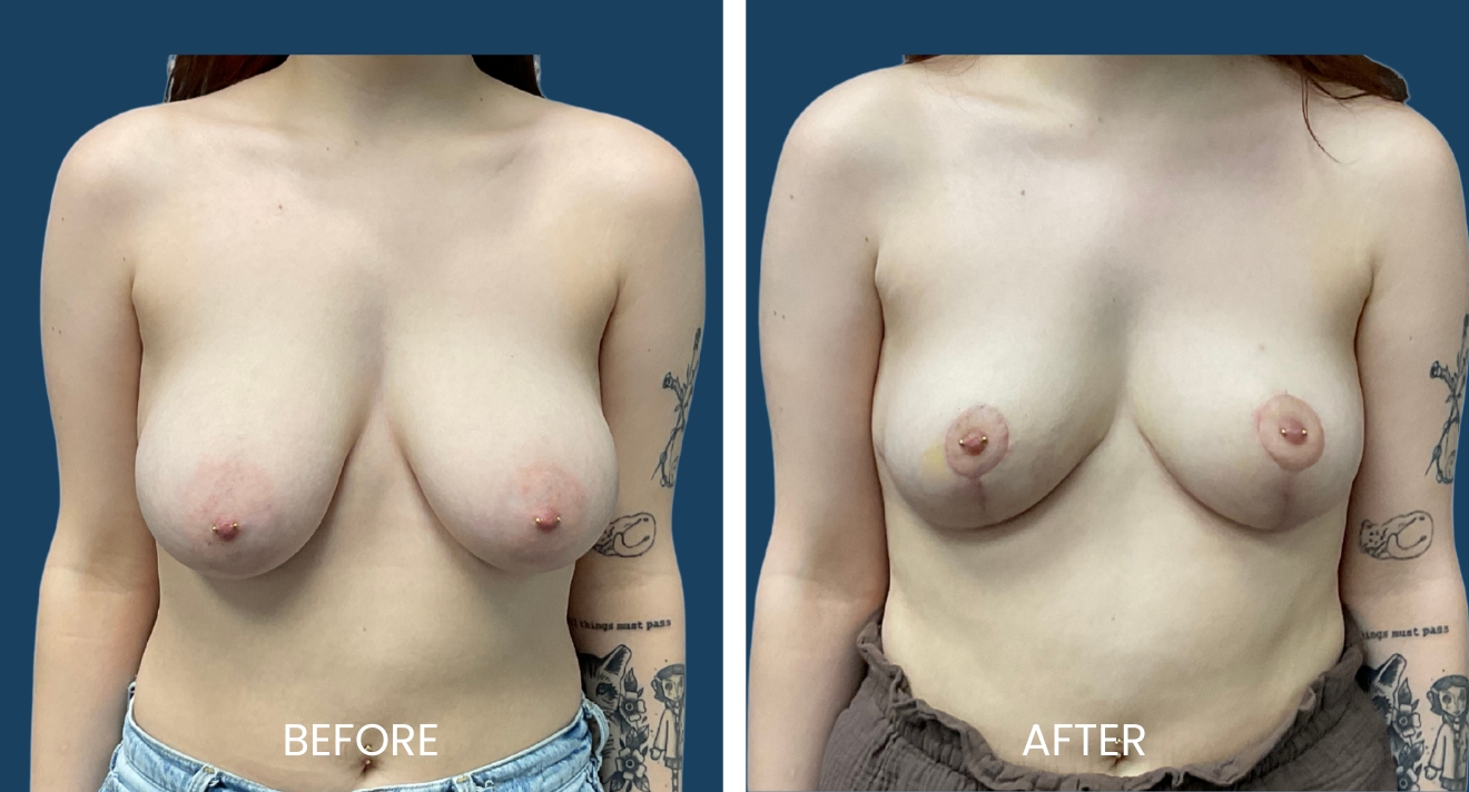 Before and after image comparison of breast augmentation results. The left side shows the 'before' appearance, highlighting natural breast shape and size. The right side displays the 'after' results, showcasing enhanced breast volume and contour following the procedure. Both images emphasize the subtle changes in appearance, providing a clear visual representation of the transformation achieved through surgery. Ideal for potential patients considering breast augmentation to understand expected outcomes and the impact of the procedure on body aesthetics.